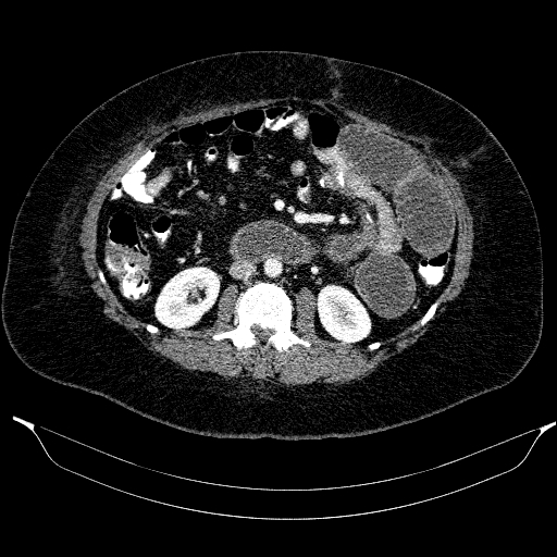 Afferent loop syndrome - secondary to incarcerated trocar site hernia (Radiopaedia 82959-97305 Axial C+ portal venous phase 112).jpg