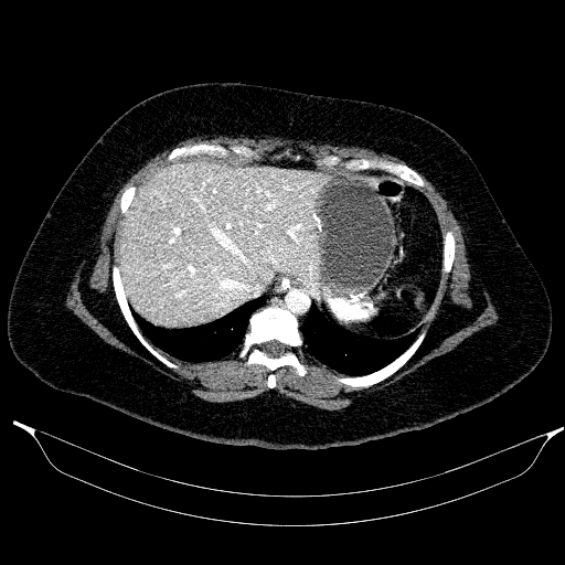 Afferent loop syndrome - secondary to incarcerated trocar site hernia (Radiopaedia 82959-97305 Axial C+ portal venous phase 38).jpg