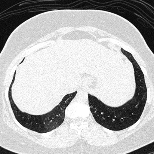 Air trapping in small airway disease (Radiopaedia 61685-69694 Axial lung window 169).jpg