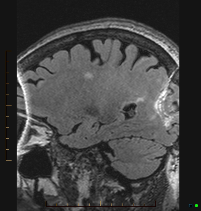 Aliasing artifact causing a spurious cerebellar lesion (Radiopaedia 48783-53810 Sagittal FLAIR 4).jpg