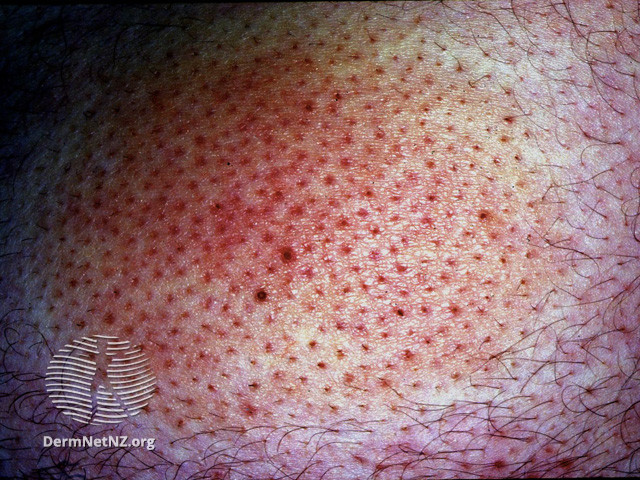 File:Alopecia mucinosa (DermNet NZ hair-nails-sweat-alop-mucin3).jpg
