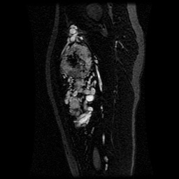 Alveolar soft part sarcoma (Radiopaedia 64501-73678 D 69).jpg