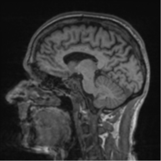 File:Alzheimer's disease- with apraxia (Radiopaedia 54763-61011 Sagittal T1 31).png