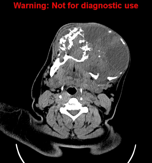 File:Ameloblastoma (Radiopaedia 33126-34164 A 15).jpg