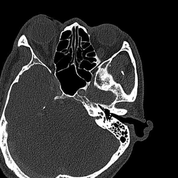 Ameloblastoma (Radiopaedia 51921-57766 Axial bone window 165).jpg