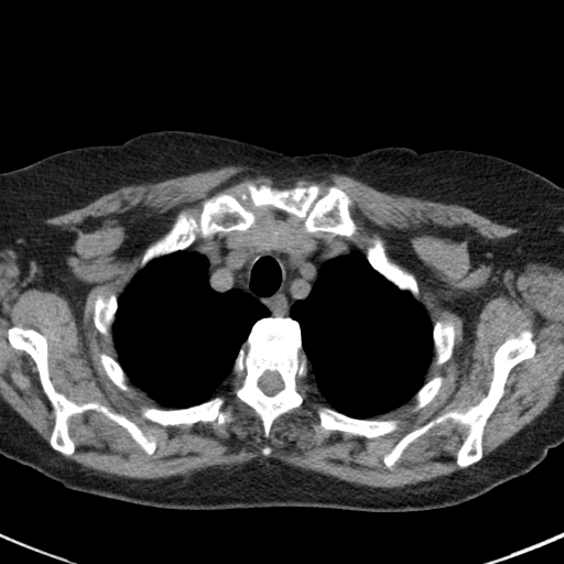 File:Amiodarone-induced pulmonary fibrosis (Radiopaedia 82355-96460 Axial non-contrast 13).jpg