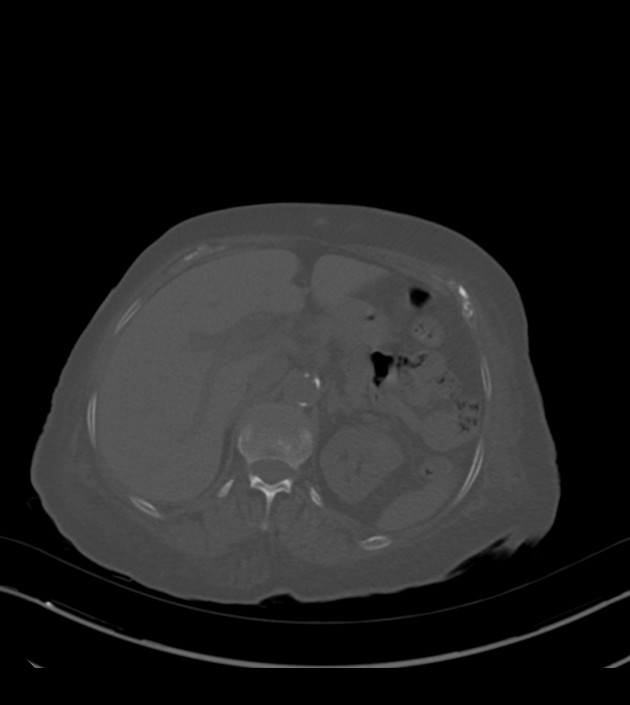 Amiodarone deposition in the liver (Radiopaedia 77587-89780 Axial bone window 86).jpg