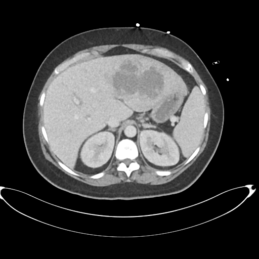 File:Amoebic liver abscess (Radiopaedia 52611-58530 A 26).png