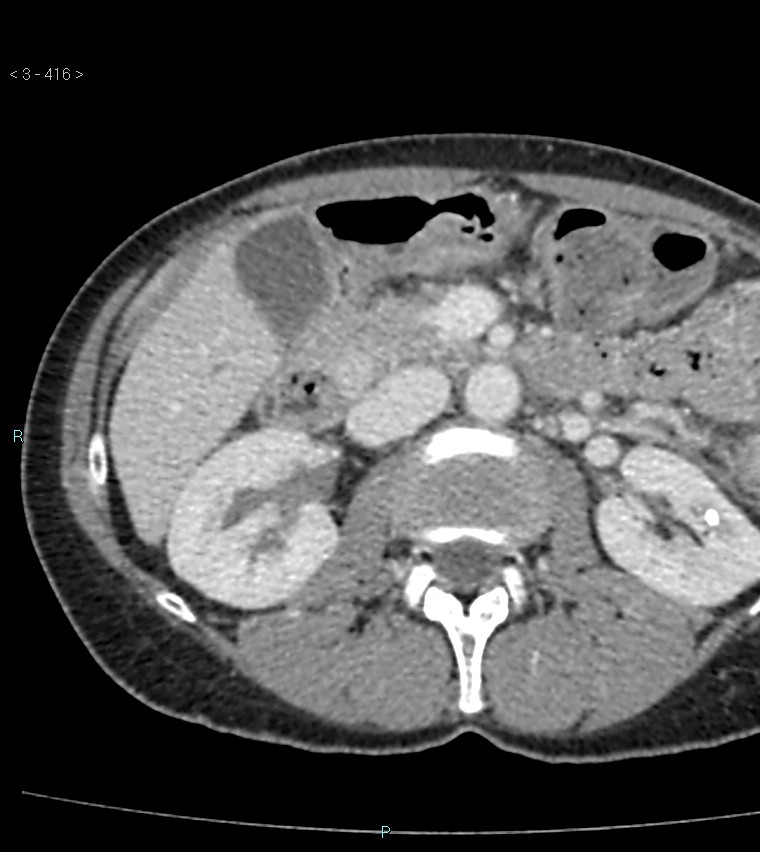 Ampulla of Vater metastasis (Radiopaedia 27820-28065 A 20).jpg