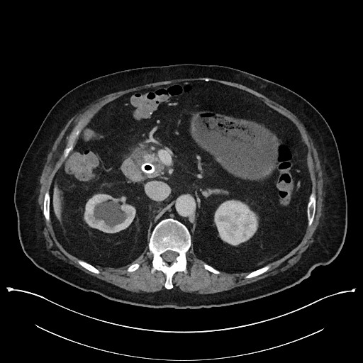 Ampullary adenocarcinoma (Radiopaedia 59373-66737 A 61).jpg
