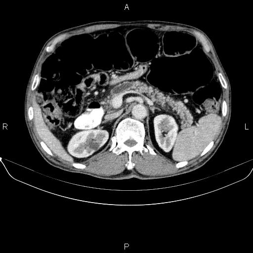 Ampullary adenocarcinoma (Radiopaedia 86093-102032 A 20).jpg