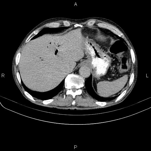Ampullary adenocarcinoma (Radiopaedia 86093-102033 Axial C+ delayed 19).jpg