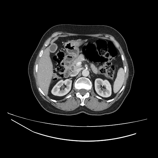 File:Ampullary tumor (Radiopaedia 60333-67998 A 25).jpg
