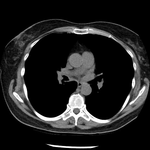 Amyloidosis - bronchial and diffuse nodular pulmonary involvement (Radiopaedia 60156-67744 Axial non-contrast 28).jpg