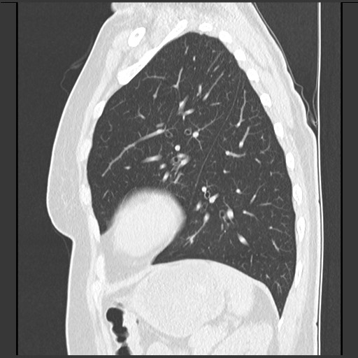 Amyloidosis - bronchial and diffuse nodular pulmonary involvement (Radiopaedia 60156-67744 F 41).jpg