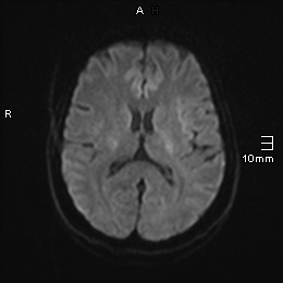 File:Amyotrophic lateral sclerosis (Radiopaedia 70821-81017 Axial DWI 8).jpg