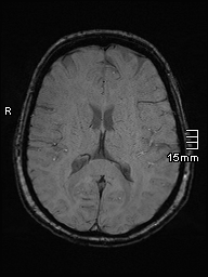 File:Amyotrophic lateral sclerosis (Radiopaedia 70821-81017 Axial SWI 30).jpg