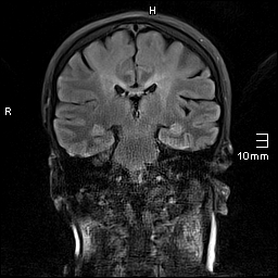 File:Amyotrophic lateral sclerosis (Radiopaedia 70821-81017 Coronal FLAIR 16).jpg