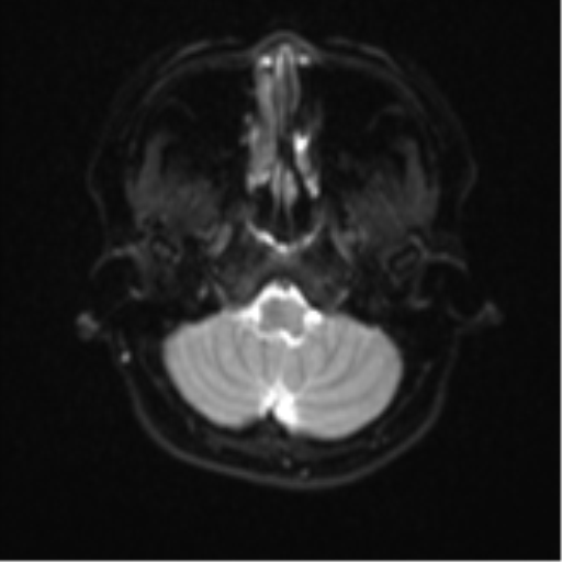Anaplastic astroblastoma (Radiopaedia 55666-62194 Axial DWI 5).png