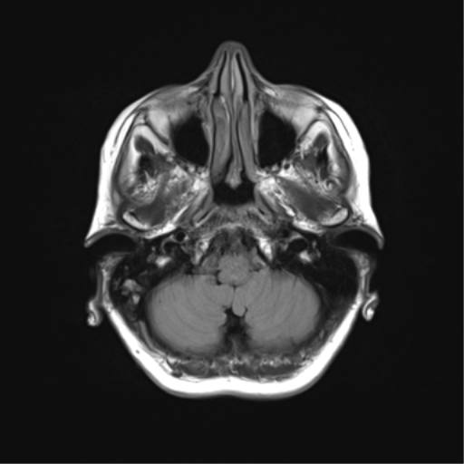 File:Anaplastic astrocytoma (Radiopaedia 86943-103160 Axial FLAIR 5).png