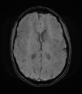 File:Anaplastic astrocytoma IDH mutant (Radiopaedia 50046-55341 Axial SWI 51).png