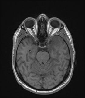 Anaplastic astrocytoma IDH wild-type (Radiopaedia 49984-55273 Axial T1 21).png