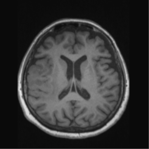 Anaplastic astrocytoma IDH wild-type (pseudoprogression) (Radiopaedia 42209-45276 Axial T1 90).png