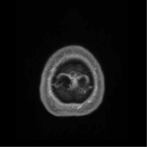 File:Anaplastic astrocytoma IDH wild-type (pseudoprogression) (Radiopaedia 42209-45276 Axial T1 C+ 143).png