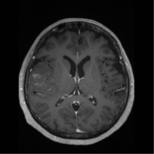 File:Anaplastic astrocytoma IDH wild-type (pseudoprogression) (Radiopaedia 42209-45276 Axial T1 C+ 83).png