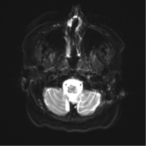 File:Anaplastic astrocytoma IDH wild-type (pseudoprogression) (Radiopaedia 42209-45279 Axial DWI 3).png