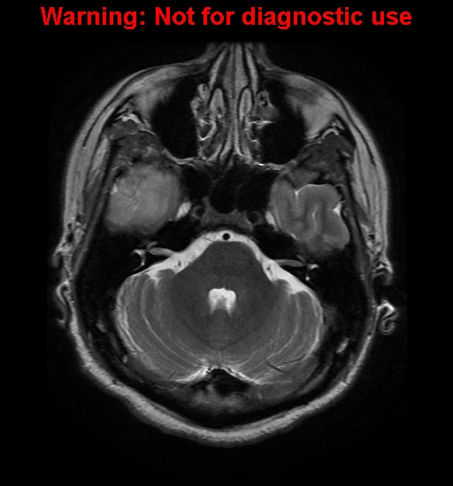 File:Anaplastic ganglioglioma (Radiopaedia 44921-48831 Axial T2 8).jpg