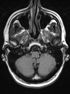 File:Anaplastic meningioma with recurrence (Radiopaedia 34452-35788 Axial T2 FLAIR 4).png