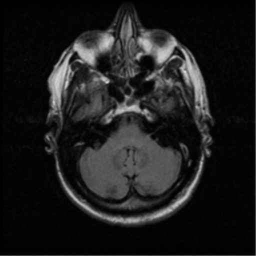 File:Anaplastic meningioma with recurrence (Radiopaedia 34452-35789 Axial FLAIR 6).png