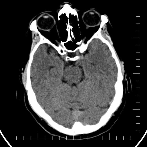 File:Aneurysm of posterior communicating artery (Radiopaedia 20188-20162 Axial non-contrast 16).jpg
