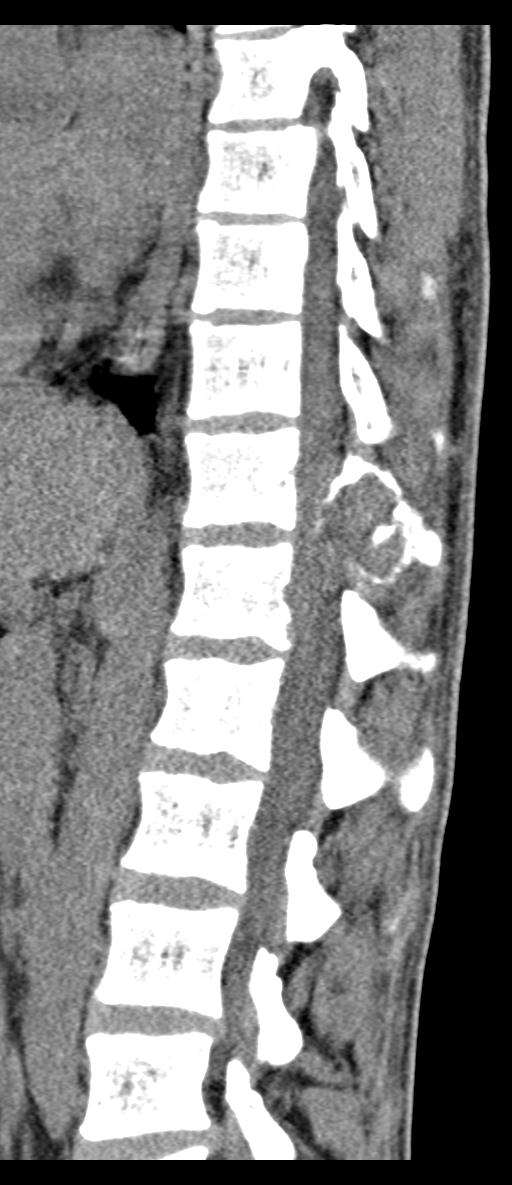 Aneurysmal bone cyst T11 (Radiopaedia 29294-29721 E 37).jpg