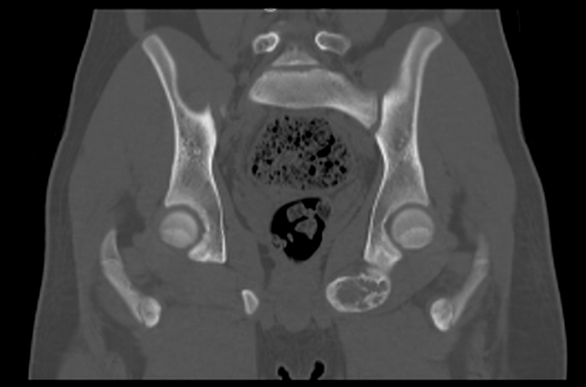 File:Aneurysmal bone cyst of ischium (Radiopaedia 25957-26094 Coronal bone window 25).png