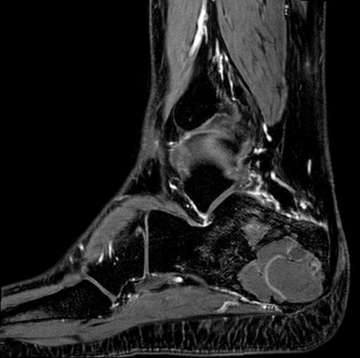 File:Aneurysmal bone cyst of the calcaneus (Radiopaedia 60669-68420 F 10).jpg