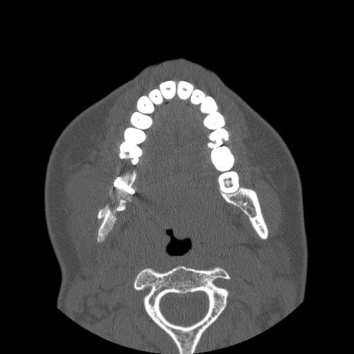 Aneurysmal bone cyst of the mandible (Radiopaedia 43280-46823 Axial bone window 65).jpg