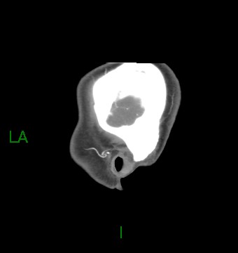 Aneurysmal subarachnoid hemorrhage with intra-axial extension (Radiopaedia 84371-99732 B 66).jpg
