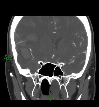 Aneurysmal subarachnoid hemorrhage with intra-axial extension (Radiopaedia 84371-99732 C 63).jpg