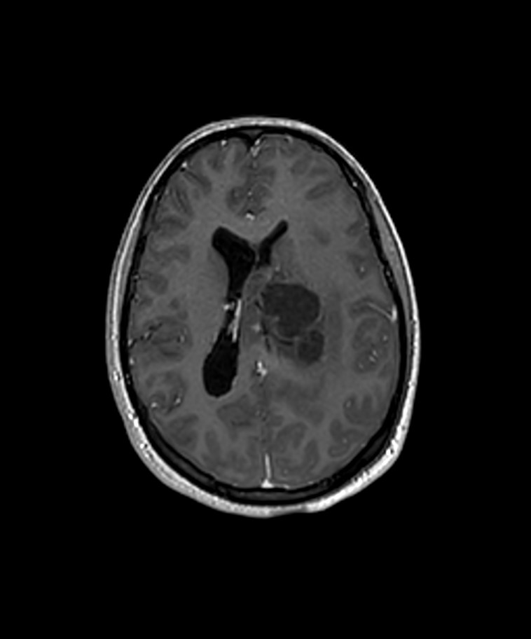 Angiomatous meningioma (Radiopaedia 79459-92577 Axial T1 C+ 3D ISO 14).jpg