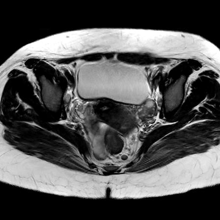 File:Ano-vaginal fistula (Radiopaedia 29765-30284 Axial T2 18).jpg