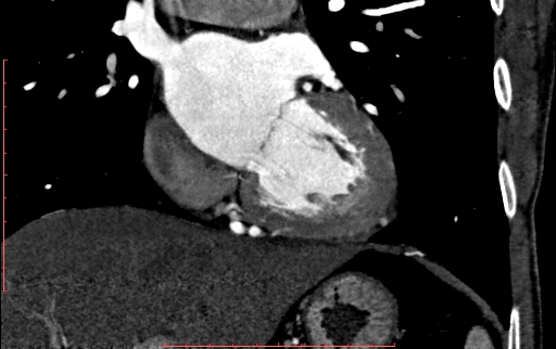 Anomalous left coronary artery from the pulmonary artery (ALCAPA) (Radiopaedia 70148-80181 B 167).jpg