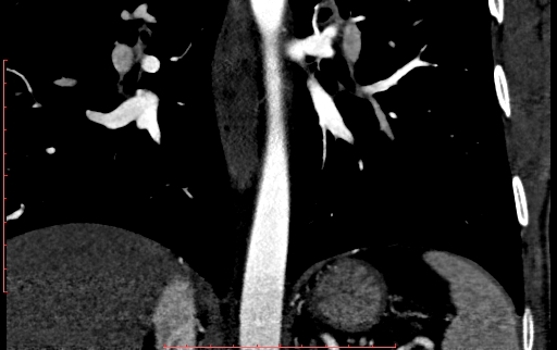 Anomalous left coronary artery from the pulmonary artery (ALCAPA) (Radiopaedia 70148-80181 B 241).jpg