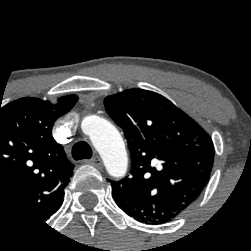 File:Anomalous left coronary artery from the pulmonary artery (ALCAPA) (Radiopaedia 72683).jpg