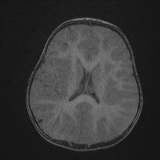 Anoxic brain injury (Radiopaedia 79165-92139 Axial MRA 158).jpg