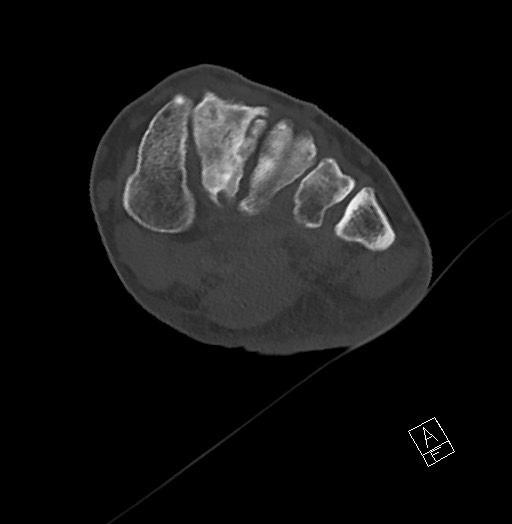 Anterior calcaneal process fracture (Radiopaedia 63353-71943 Axial bone window 76).jpg
