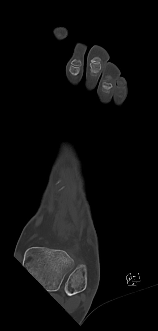 Anterior calcaneal process fracture (Radiopaedia 63353-71943 Coronal bone window 12).jpg