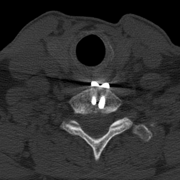 Anterior cervical postdiscectomy arthrodesis (Radiopaedia 32678-33646 Axial bone window 60).jpg
