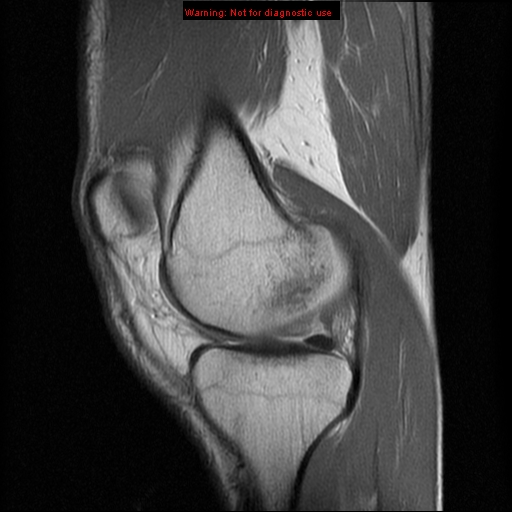 File:Anterior cruciate ligament injury - partial thickness tear (Radiopaedia 12176-12515 Sagittal PD 7).jpg